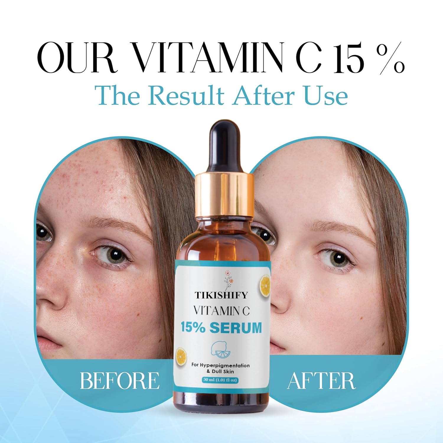 Vitamin C 15% Serum for Hyperpigmentation & Dull Skin, 30ml